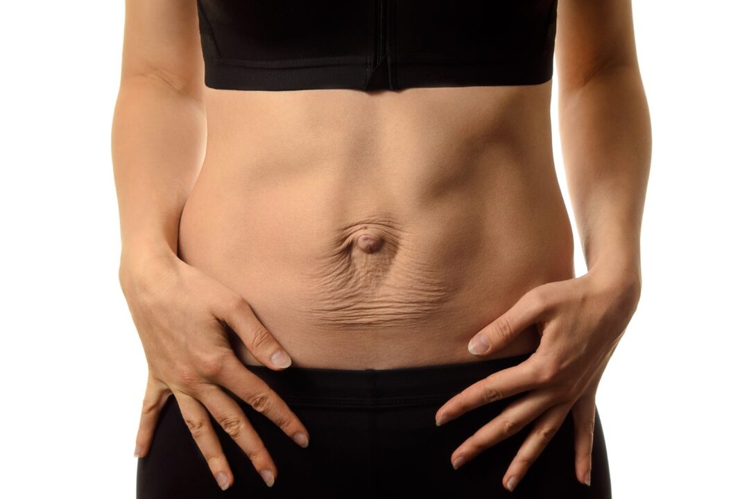 Diastasis recti